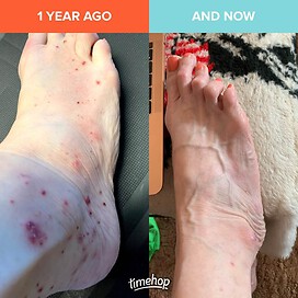 side by side foot with palmoplantar pustulosis 1 year later