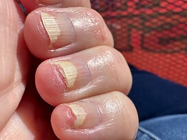 The 3 affected nails on left hand