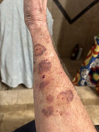 Mysterious bruising