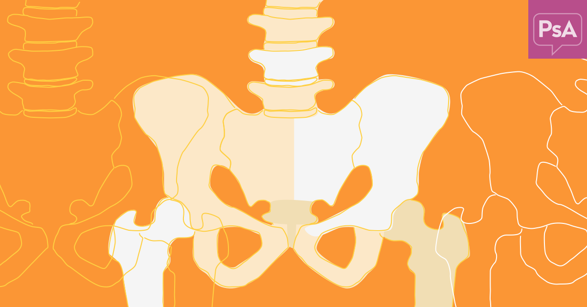 Is Sacroiliitis Different Than Psoriatic Arthritis? | Psoriatic