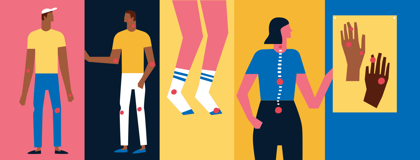 Five people showing five different types of psoriatic arthritis