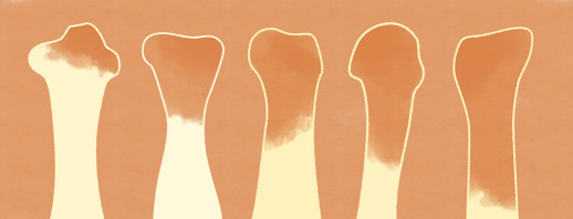 Psoriatic Arthritis and Bone Erosions image