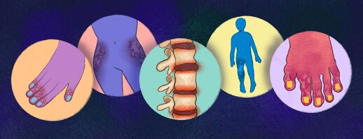 Five Types of Psoriatic Arthritis image