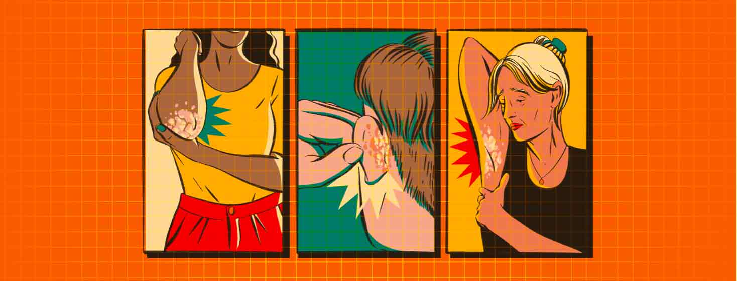 Three panels showing some of the worst areas for psoriasis - the joints, behind the ear, and in the armpit inverse areas, painful plaques, flaking skin, pain, discomfort, comic book style adult Black female, adult male, senior female