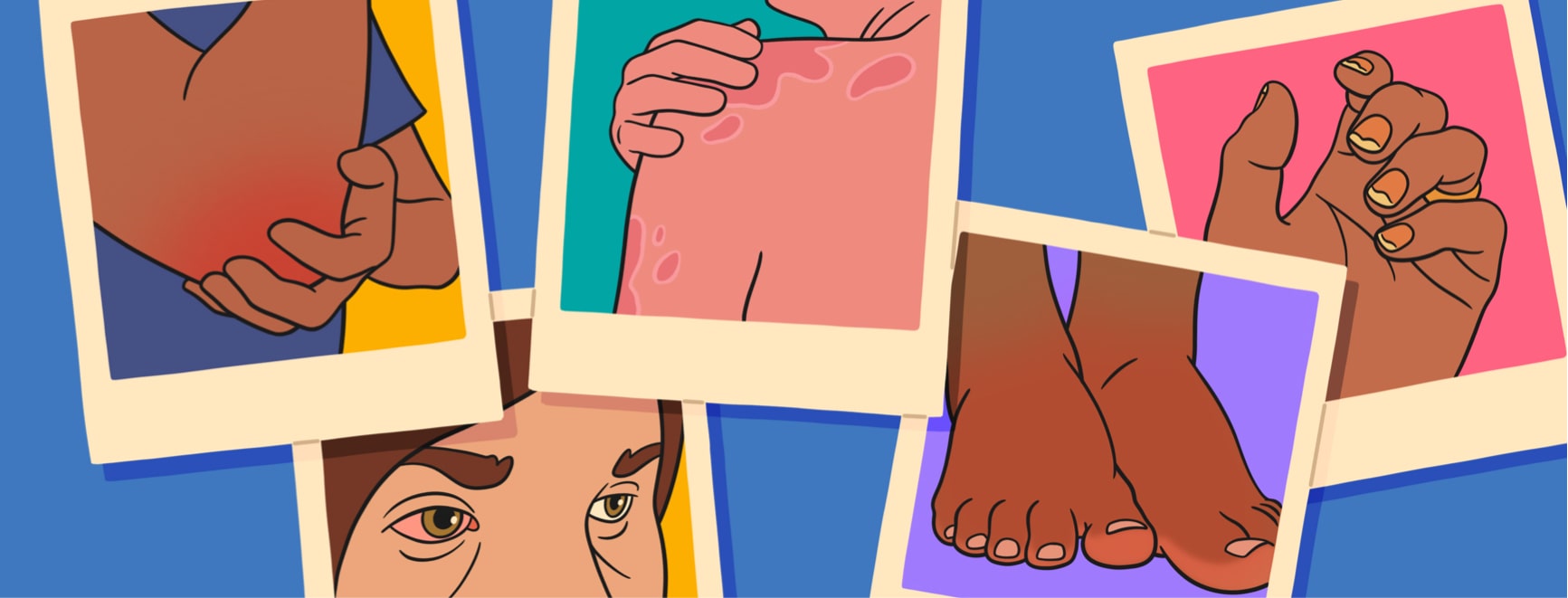 Several unique symptoms of psoriatic arthritis are presented in a collage of polaroid snapshots.