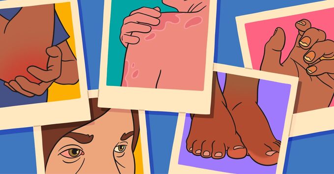 The 7 Psins (Sins with a Silent P) of Psoriatic Arthritis image