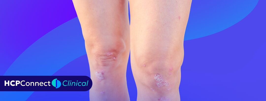 Tailoring Systemic Therapy to the Clinical Domains of Psoriatic Arthritis image